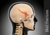 Skull Fracture Exercises for Faster Recovery Skull Fracture Exercises for Faster Recovery
