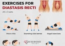 Diastasis Recti Exercises for a Stronger, Healthier Midsection